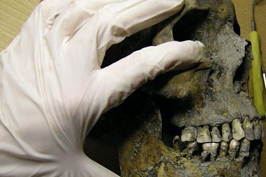 PLOS ONE: 60% викингов страдали от кариеса, а некоторые спиливали больные зубы